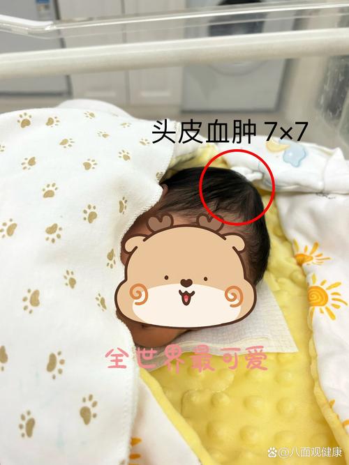 新生儿头皮血肿多久能自然吸收？-第2张图片-中州医学会