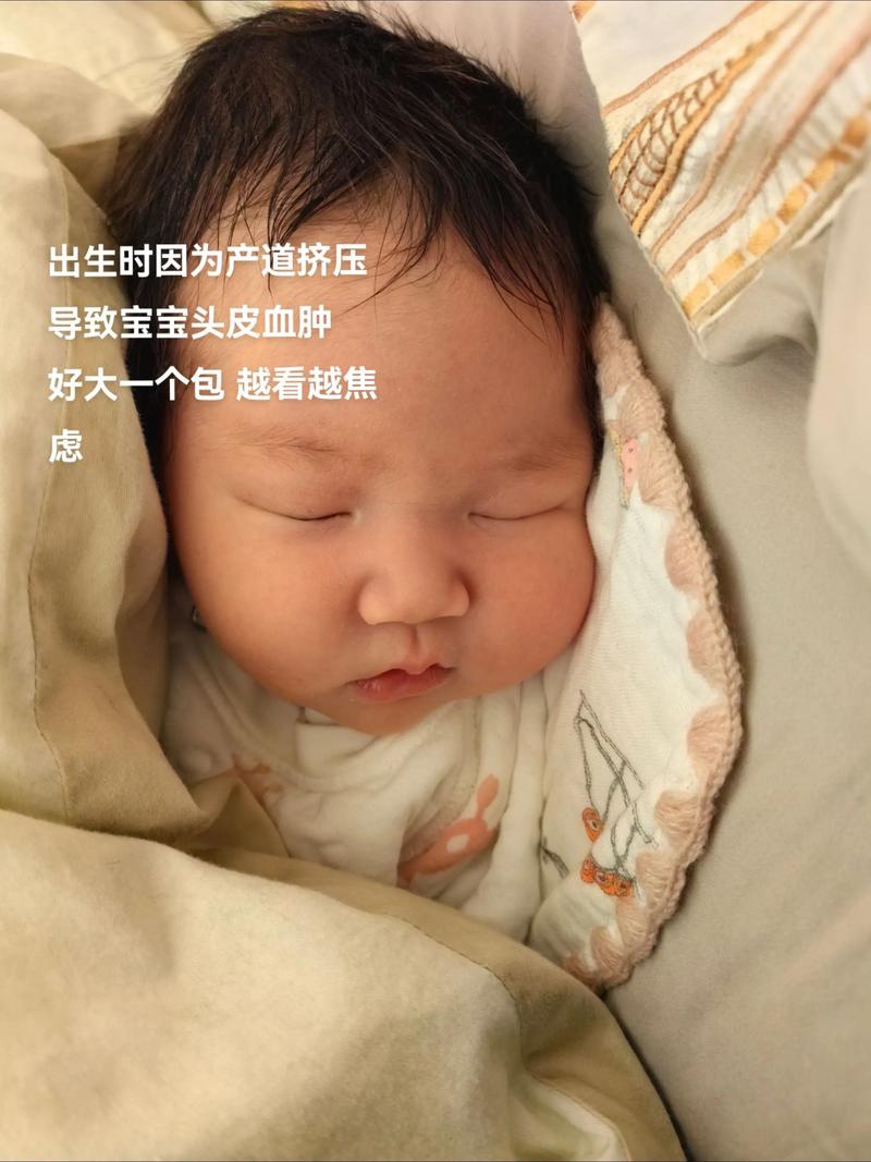 新生儿头皮血肿多久能自然吸收？-第1张图片-中州医学会