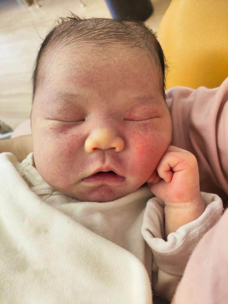 新生儿头皮血肿多久能自然吸收？-第3张图片-中州医学会