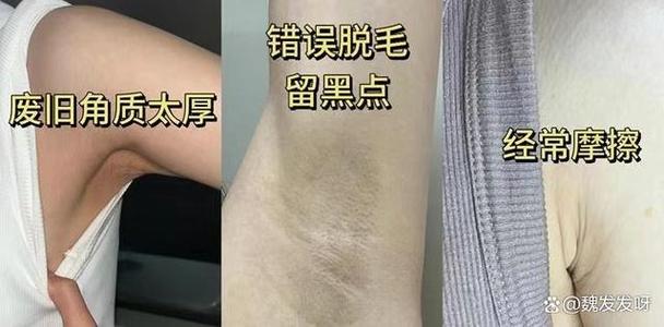 孕期腋下变黑能辨胎儿性别吗？-第3张图片-中州医学会