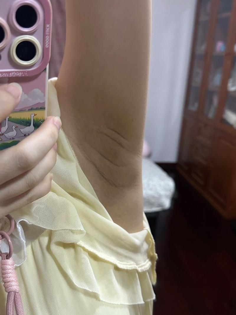 孕期腋下变黑能辨胎儿性别吗？-第2张图片-中州医学会