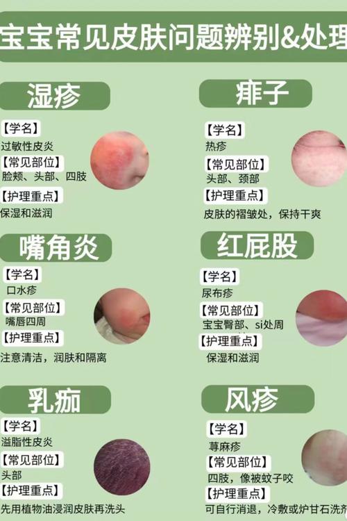 新生儿湿疹怎么办？-第2张图片-中州医学会