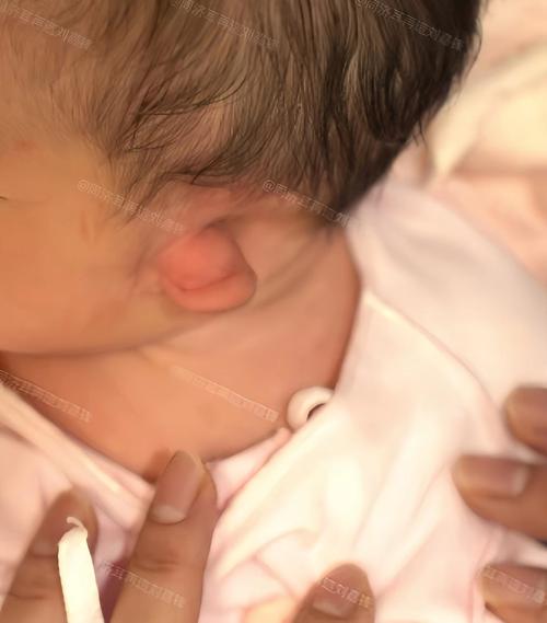 新生儿两耳大小不一怎么办？-第1张图片-中州医学会