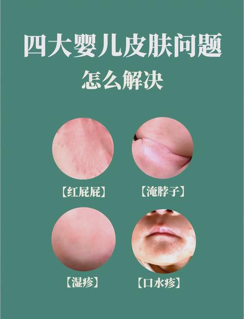 新生儿脸干脱皮，咋办？-第2张图片-中州医学会