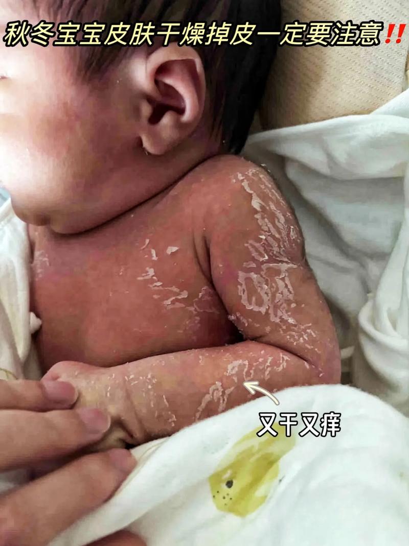 新生儿脸干脱皮，咋办？-第3张图片-中州医学会