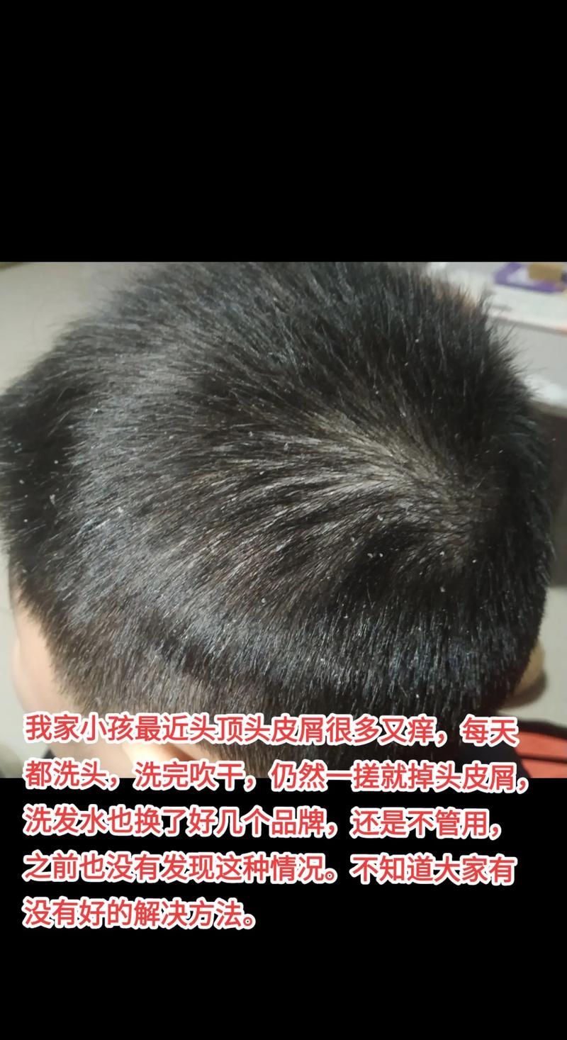 儿童头皮屑多，是缺营养还是生病了？-第2张图片-中州医学会