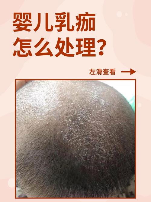 儿童头皮屑多，是缺营养还是生病了？-第3张图片-中州医学会