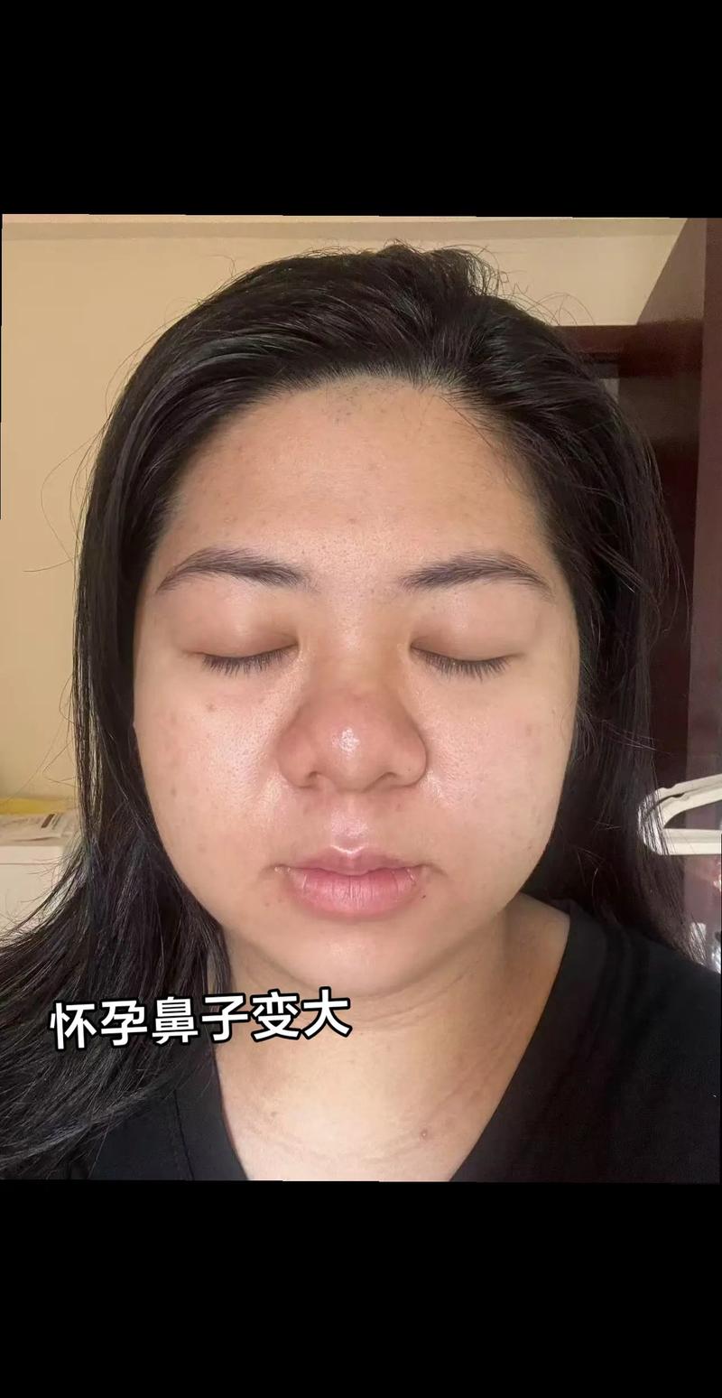 怀孕期鼻子变大是激素作怪吗?-第2张图片-中州医学会 怀孕期鼻子变大是激素作怪吗?-第2张图片-中州医学会
