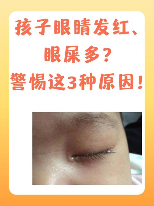 新生儿眼角发红是何原因？-第2张图片-中州医学会