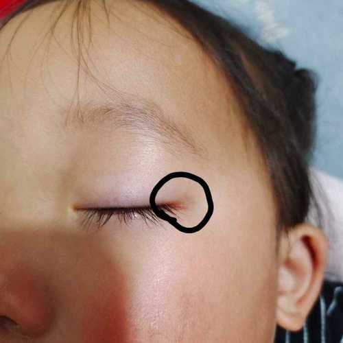 新生儿眼角发红是何原因？-第3张图片-中州医学会