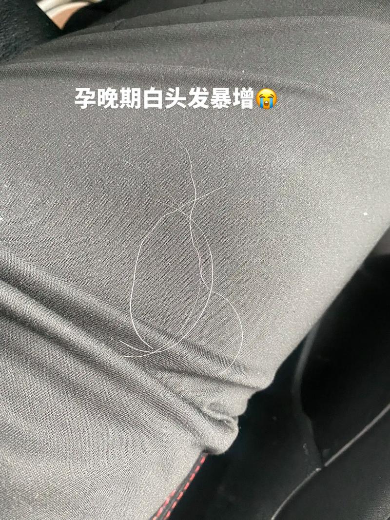 孕期为何长白头发？是激素还是营养缺了？-第2张图片-中州医学会