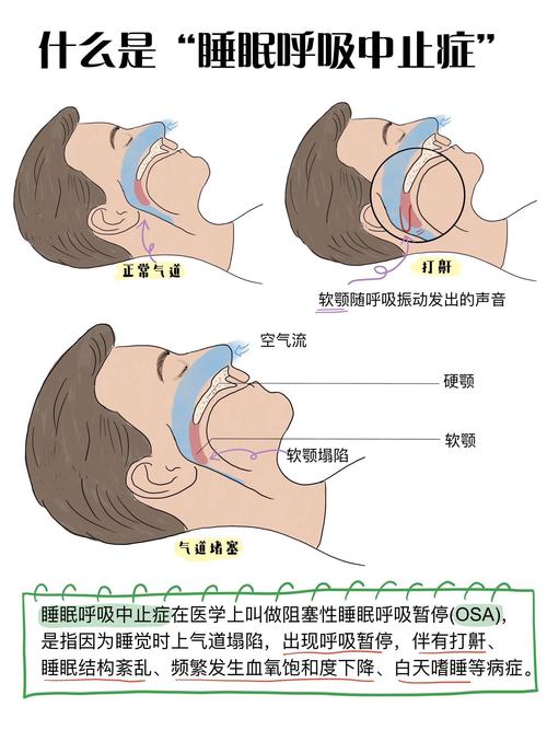 儿童阻塞性睡眠呼吸暂停综合征有何危害?-第3张图片-中州医学会 儿童阻塞性睡眠呼吸暂停综合征有何危害?-第3张图片-中州医学会