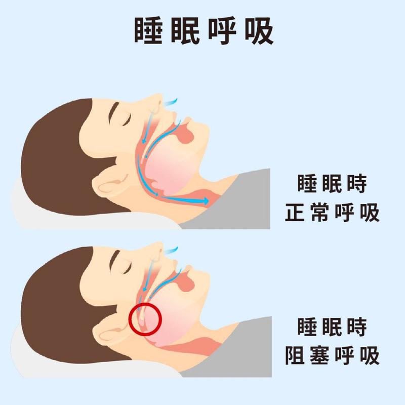 儿童阻塞性睡眠呼吸暂停综合征有何危害?-第2张图片-中州医学会 儿童阻塞性睡眠呼吸暂停综合征有何危害?-第2张图片-中州医学会