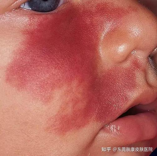 新生儿红色胎记症状有哪些？-第2张图片-中州医学会