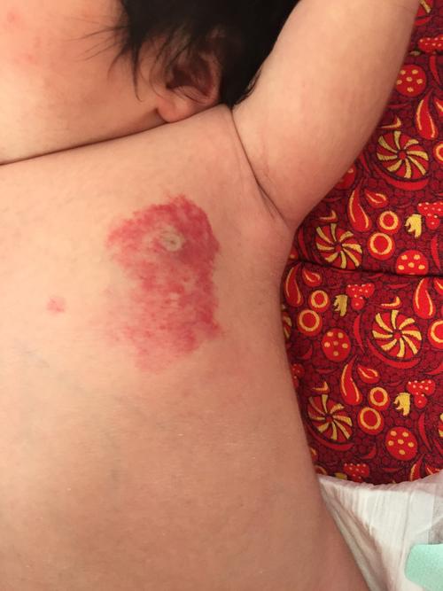 新生儿红色胎记症状有哪些？-第3张图片-中州医学会