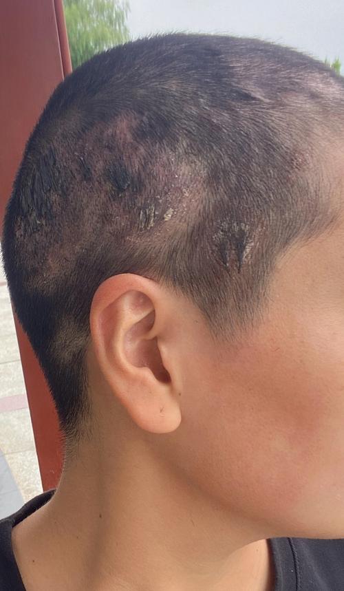 儿童脂溢性皮炎能根治吗？-第1张图片-中州医学会