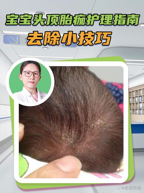 儿童脂溢性皮炎能根治吗？-第2张图片-中州医学会
