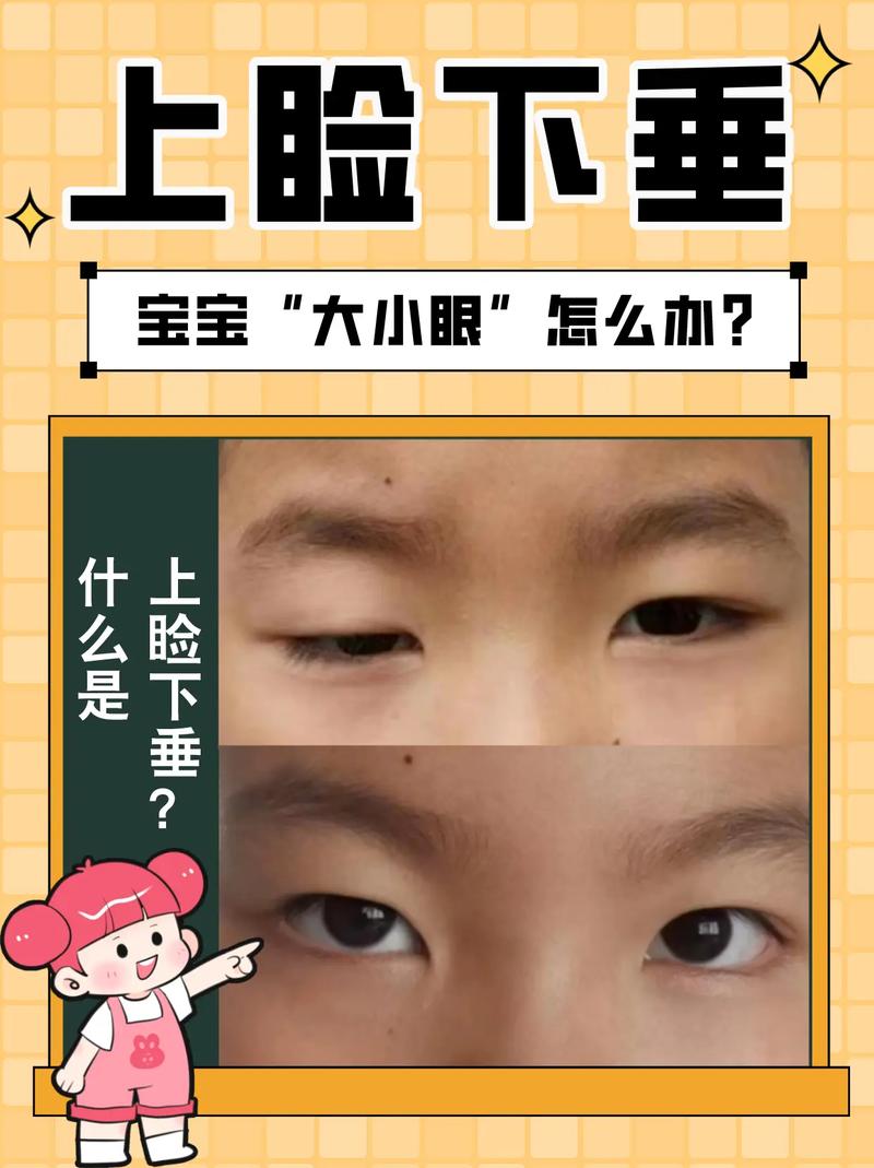 新生儿双眼大小不一，需警惕吗？-第2张图片-中州医学会