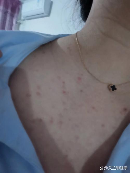 孕期肚子长痘痘是激素变化还是皮肤问题？-第3张图片-中州医学会