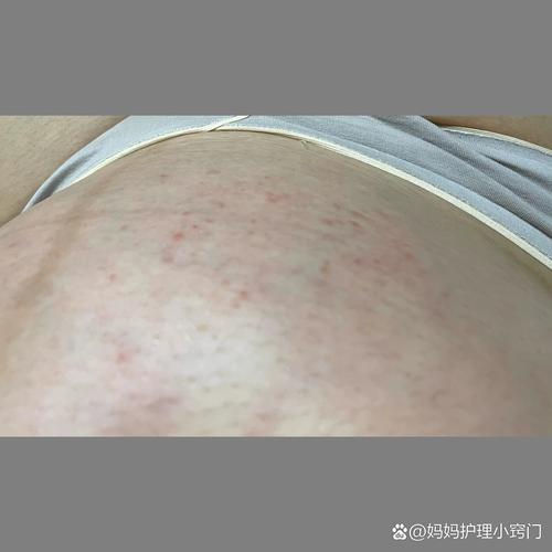 孕期肚子长痘痘是激素变化还是皮肤问题？-第2张图片-中州医学会