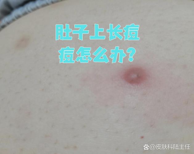 孕期肚子长痘痘是激素变化还是皮肤问题？-第1张图片-中州医学会