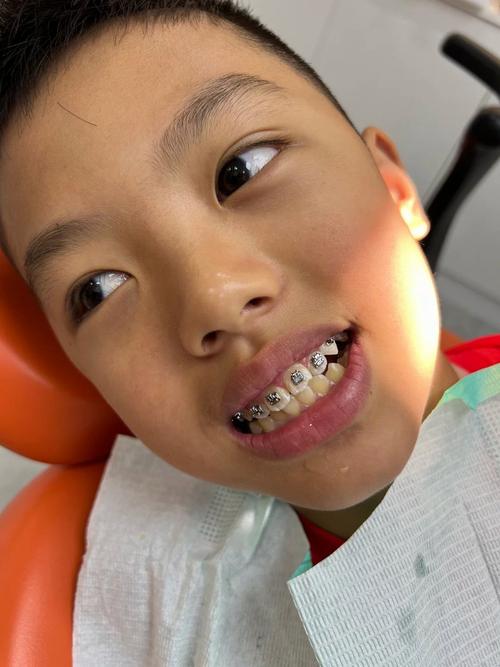 儿童地包天矫正，几岁开始最合适？-第1张图片-中州医学会