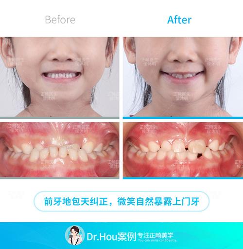 儿童地包天矫正，几岁开始最合适？-第2张图片-中州医学会