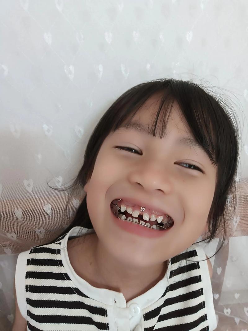 儿童地包天矫正，几岁开始最合适？-第3张图片-中州医学会