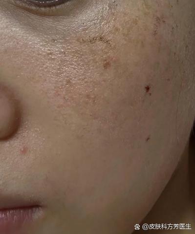 孕期斑产后怎么才能消？-第3张图片-中州医学会