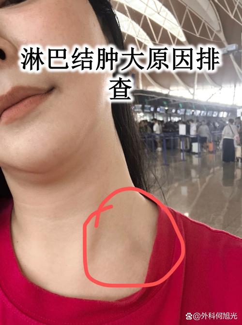 儿童腹部淋巴结肿大是何因？-第3张图片-中州医学会