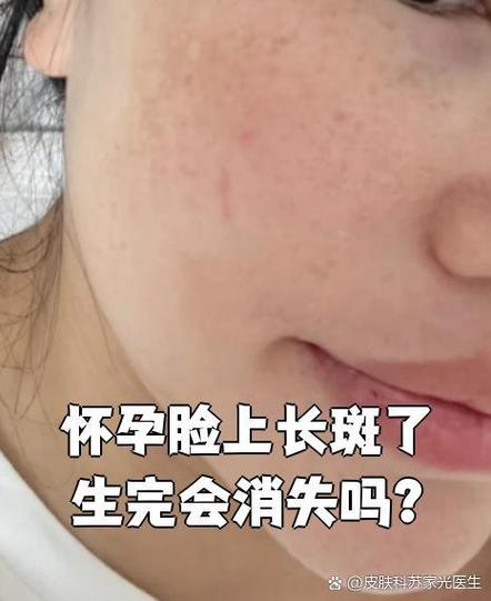 孕期脸长斑是激素还是营养问题？-第1张图片-中州医学会