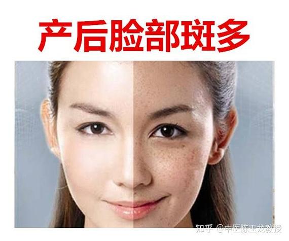 孕期脸长斑是激素还是营养问题？-第2张图片-中州医学会
