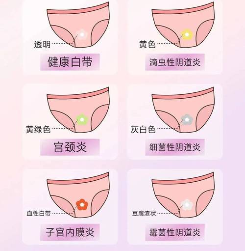 怀孕黄色分泌物正常吗？-第1张图片-中州医学会