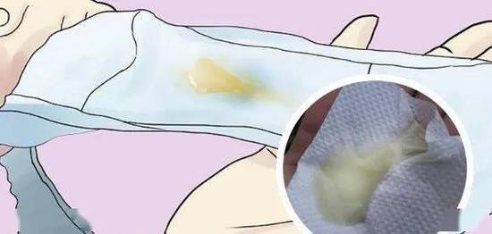 怀孕黄色分泌物正常吗？-第2张图片-中州医学会