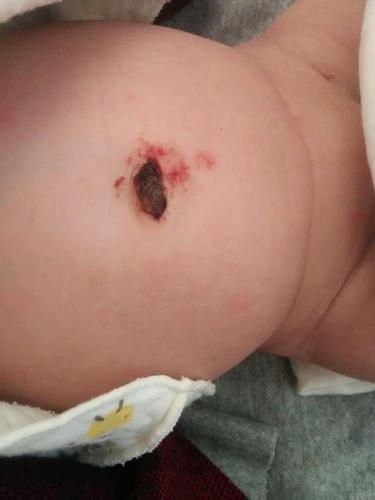 新生儿肚脐出血能洗澡吗？-第1张图片-中州医学会