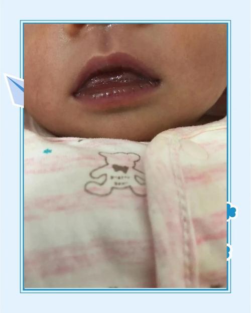 新生儿嘴周发青是缺氧还是其他问题？-第1张图片-中州医学会