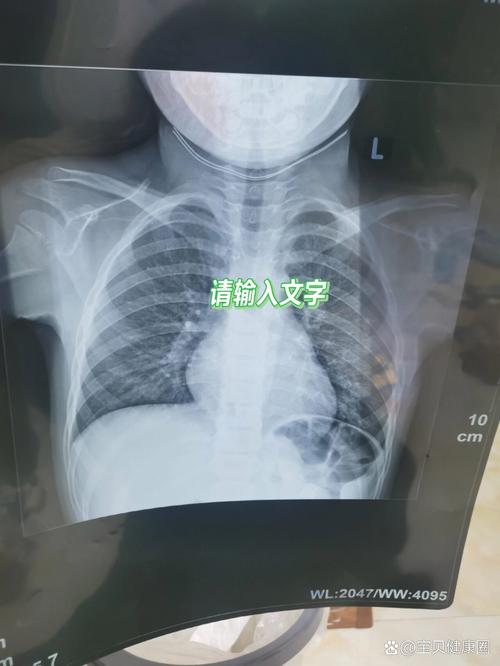 新生儿拍片肺炎诊断,是过度医疗还是真骗局?-第2张图片-中州医学会 新生儿拍片肺炎诊断,是过度医疗还是真骗局?-第2张图片-中州医学会