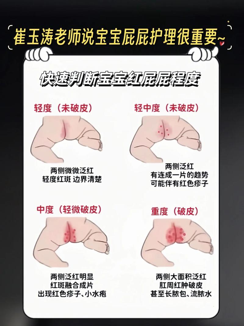 新生儿肛门发红是何原因？-第1张图片-中州医学会