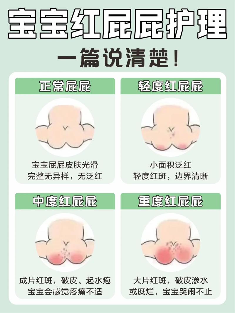 新生儿肛门发红是何原因？-第3张图片-中州医学会