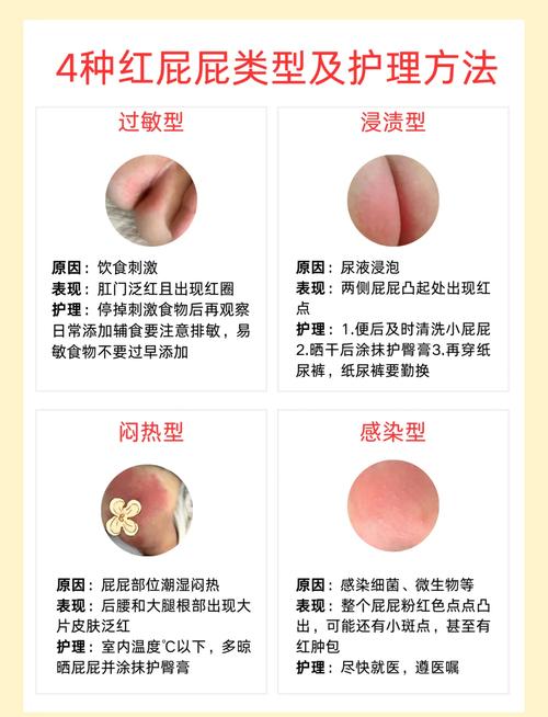 新生儿肛门发红是何原因？-第2张图片-中州医学会