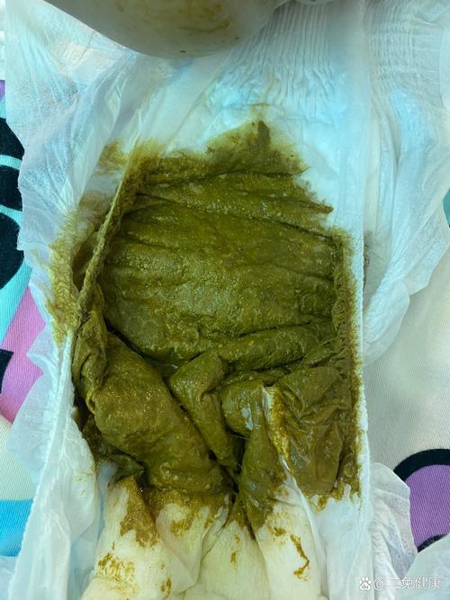 新生儿绿色大便何因？-第1张图片-中州医学会