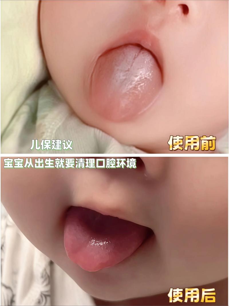 新生儿母乳喂养舌苔发白是何原因？-第3张图片-中州医学会
