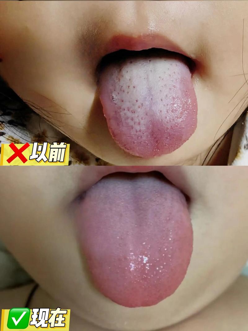 新生儿母乳喂养舌苔发白是何原因？-第1张图片-中州医学会