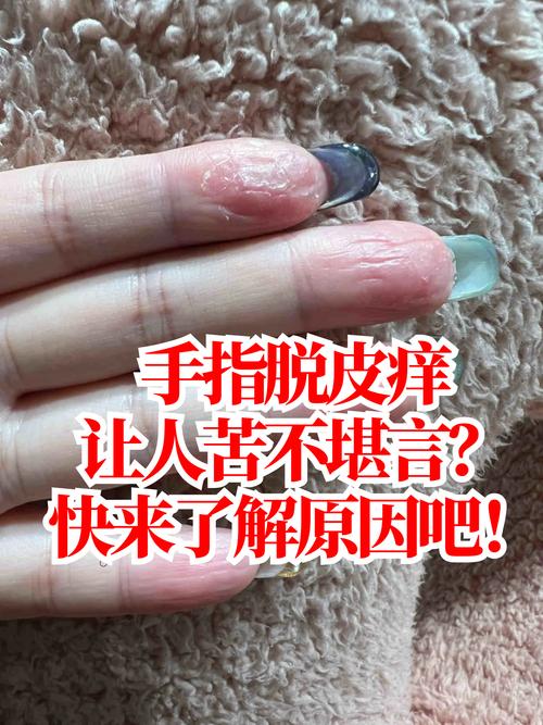 儿童手指脱皮是缺维生素还是皮肤病？-第1张图片-中州医学会
