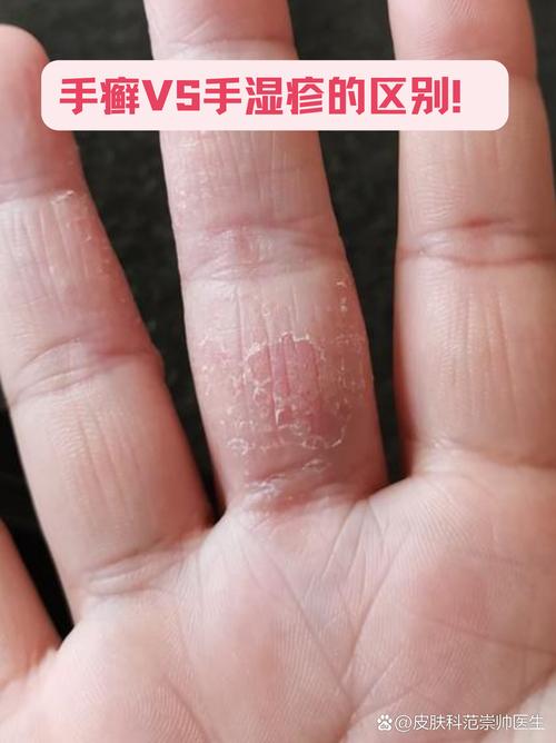儿童手指脱皮是缺维生素还是皮肤病？-第2张图片-中州医学会