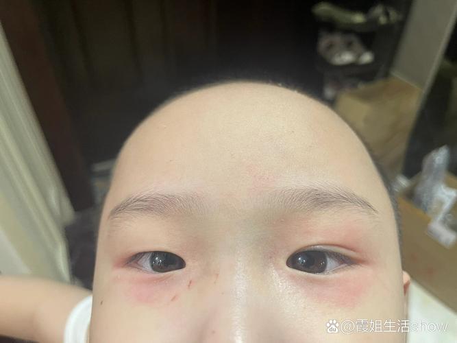 新生儿眼角发红是何原因？-第2张图片-中州医学会