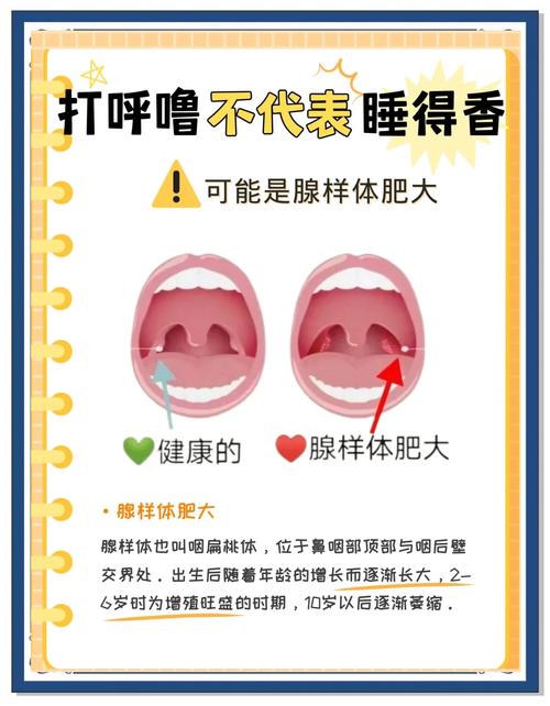 儿童腺样体肥大，哪种治疗方式更优？-第2张图片-中州医学会