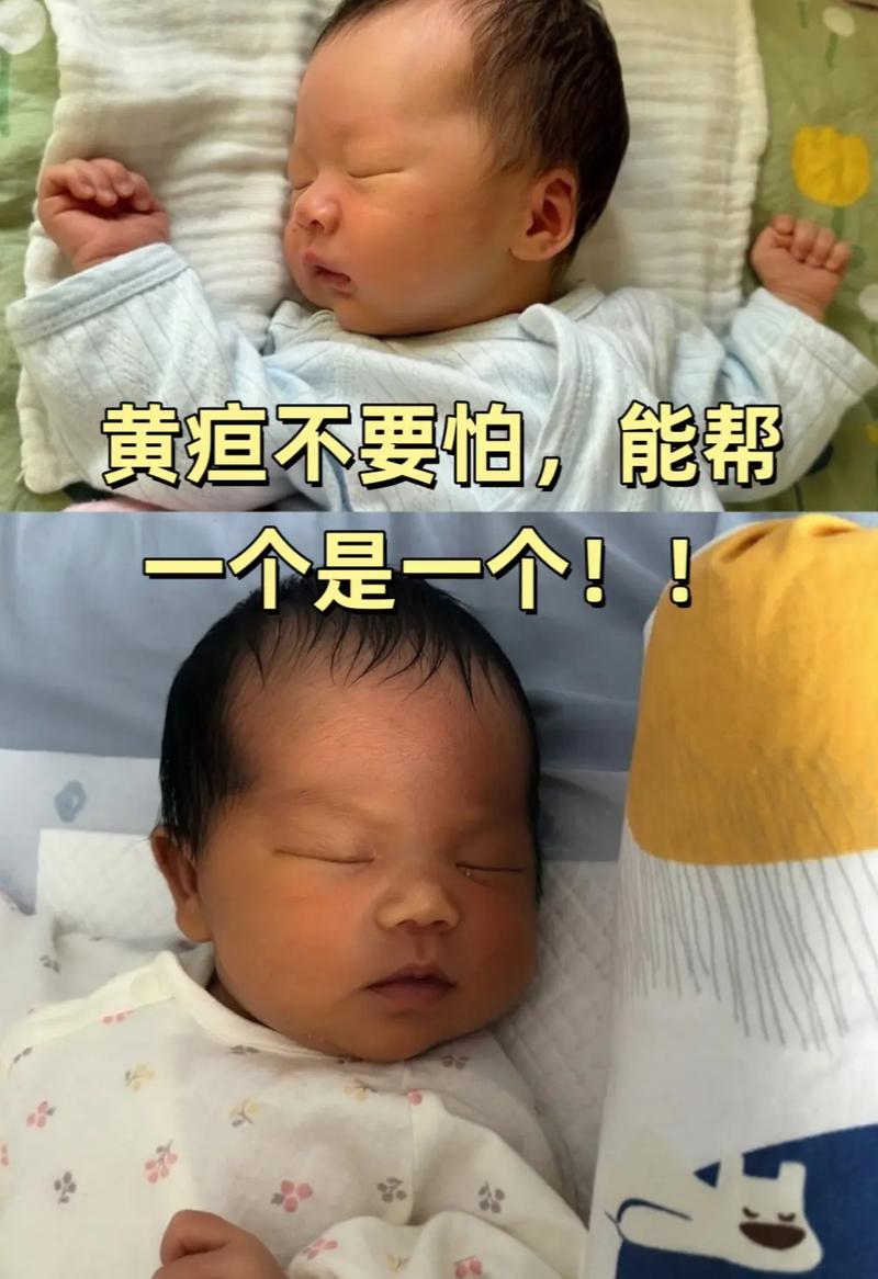 新生儿直接胆红素20多严重吗?-第2张图片-中州医学会 新生儿直接胆红素20多严重吗?-第2张图片-中州医学会