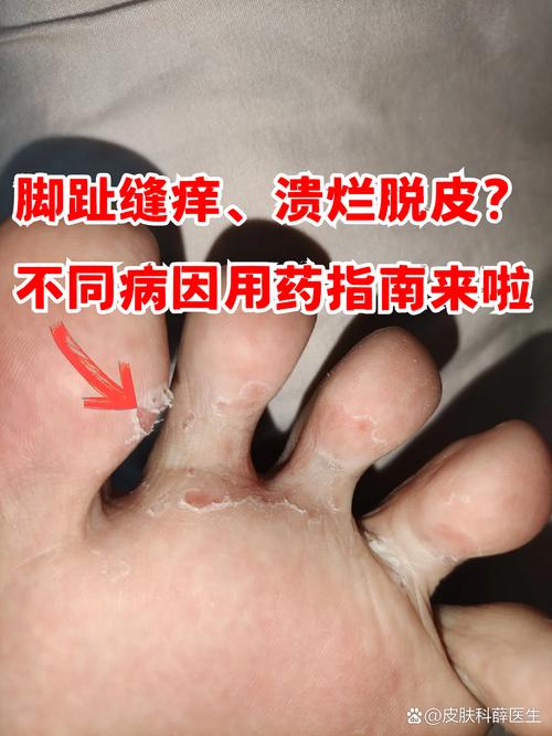 孕期脚气脚趾缝痒，怎么办？-第1张图片-郑州医学网