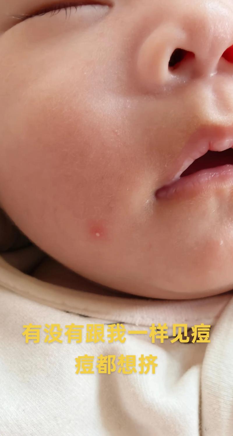 孕期挤痘痘会影响胎宝宝吗？-第2张图片-中州医学会